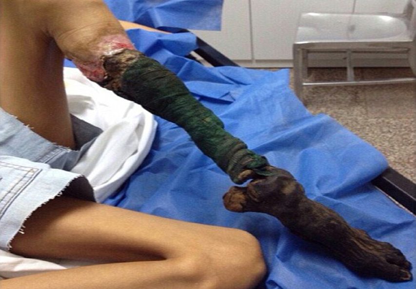 Biedējošs skats: 13 gadīga meitene pēc čūskas kodiena pārvēršas par mūmiju 1